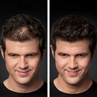 Homem com antes e depois de tratamento capilar mostrando aumento do cabelo na parte frontal