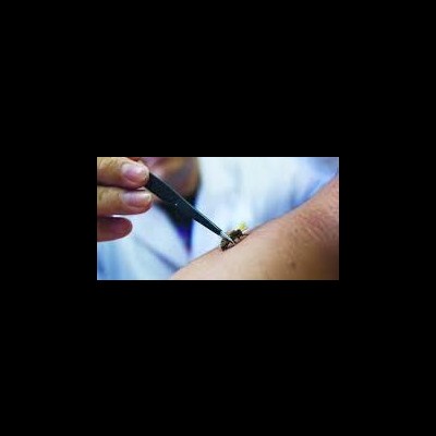 Pessoa usando pinça para remover inseto da pele.