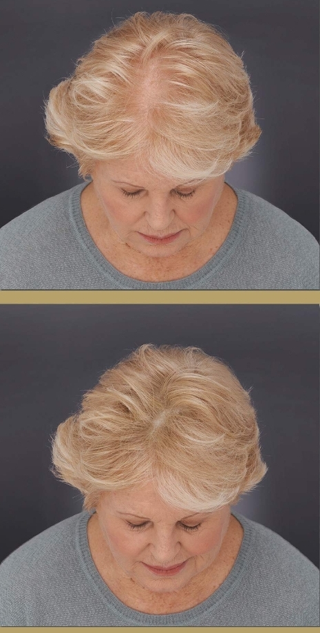 Antes e depois da aplicação de peça capilar loira em mulher idosa