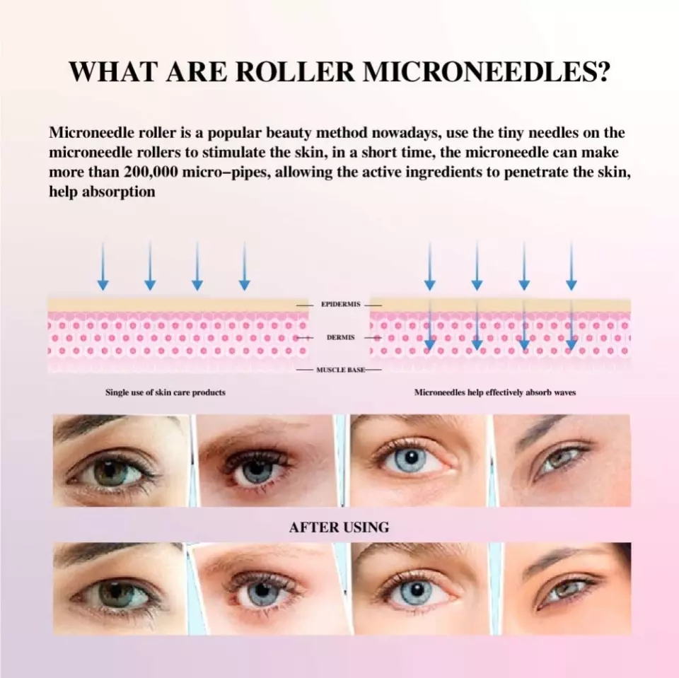 Infográfico sobre roller microneedles com texto, diagramas da pele e fotos antes e depois do uso