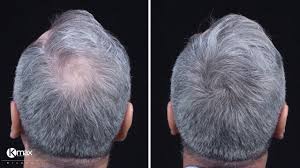 Antes e depois de densidade capilar num homem com cabelo grisalho