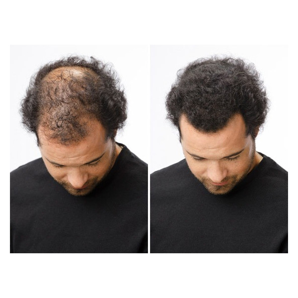 Antes e depois do cabelo de um homem com diferença visível na densidade.