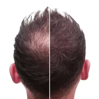 Cabeça de homem vista de trás com cabelo ralo à esquerda e cabelo denso à direita.