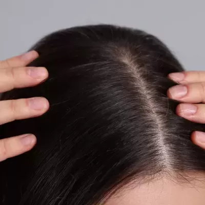 Topo da cabeça com cabelo castanho escuro e couro cabeludo visível