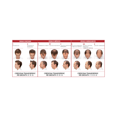 Homens com diferentes graus de calvície, visto de cima e lateral, em imagem classificativa para tratamento capilar.