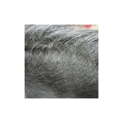 Cabelo escuro com caspa visível