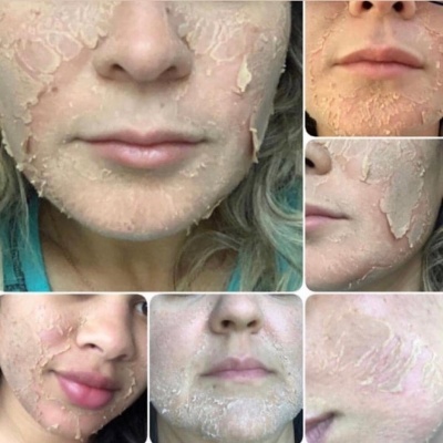 Pessoas com máscaras faciais esfoliantes a descamar no rosto.
