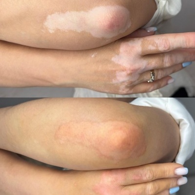 Braços com manchas de pele despigmentada típicas de vitiligo