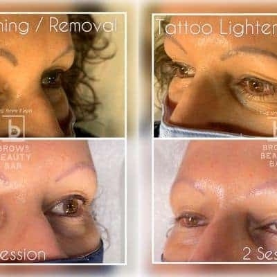 Comparação antes e depois de remoção de tatuagem em sobrancelhas femininas.
