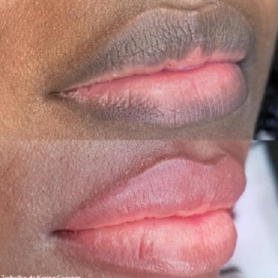 Close-up de dois conjuntos de lábios, um seco e escurecido e outro hidratado e rosado.