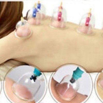 Pessoa com ventosas transparentes coloridas aplicadas nas costas para tratamento terapêutico.