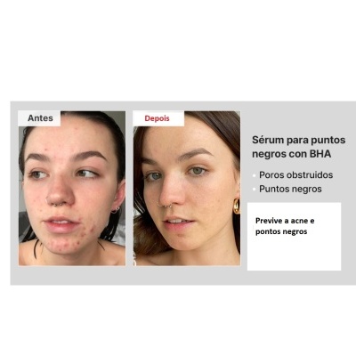 Imagem comparativa antes e depois do uso de sérum para pontos negros com BHA mostrando melhoria na pele