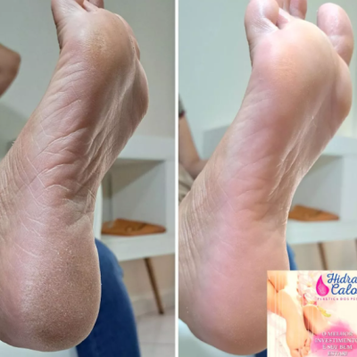 Comparação de pé seco e pé hidratado com selo Hidra Calc