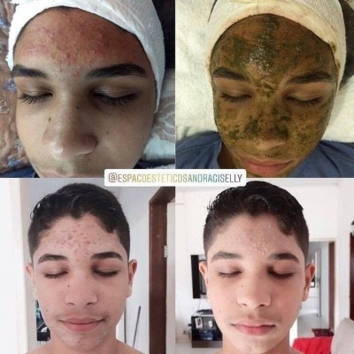 Antes e depois de tratamento de acne em jovem, incluindo aplicação de máscara facial verde.