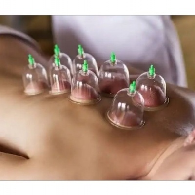 Pessoa deitada com ventosas transparentes aplicadas nas costas em sessão de terapia