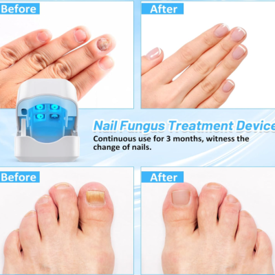 Dispositivo de tratamento de fungos nas unhas e imagens antes e depois do tratamento nas mãos e pés