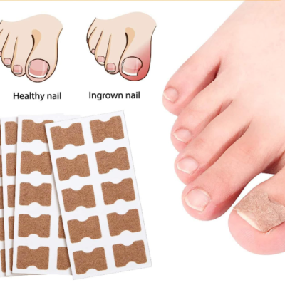 Pé com curativo adesivo em unha encravada e ilustrações de unha saudável e encravada