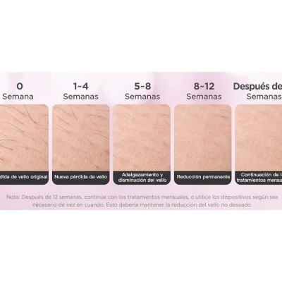Cinco fases de tratamento capilar em pele mostrando redução progressiva de pêlos