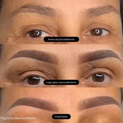 Antes do procedimento sobrancelhas naturais e ralas, logo após o procedimento sobrancelhas pigmentadas em marrom médio, cicatrizada sobrancelha com pigmento marrom médio.