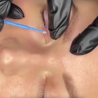 Frascos de gel arrefecedor com lidocaína e aplicação na pele junto aos olhos.