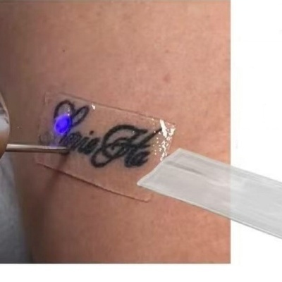Remoção de tatuagem temporária com dispositivo de luz azul num braço
