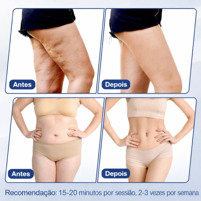 Fotos de antes e depois de tratamento mostrando pernas e abdómen de uma pessoa com roupa interior bege e texto de recomendação.