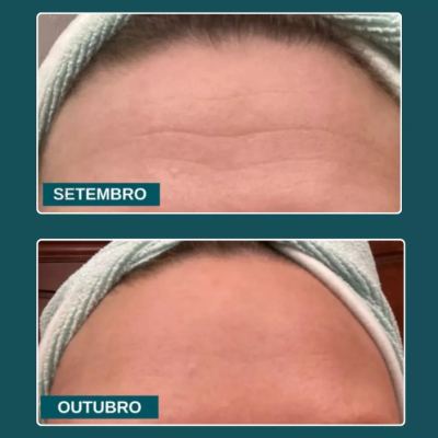 Comparação da testa em setembro e outubro com uma toalha verde na cabeça