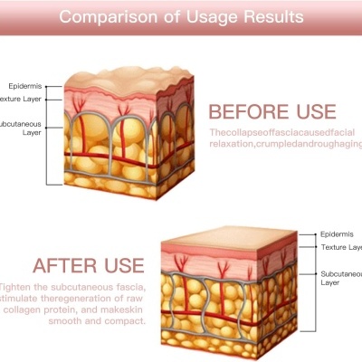 Comparação da pele antes e depois do uso do produto com camadas da pele destacadas