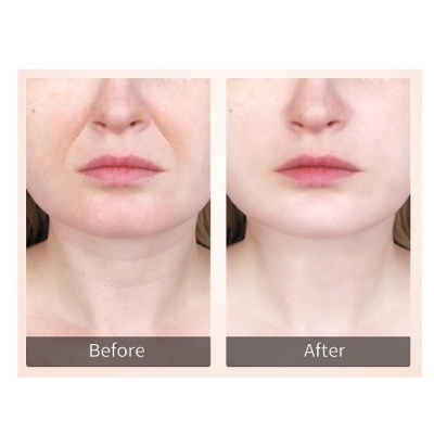 Foto antes e depois mostrando mudanças no rosto da mulher