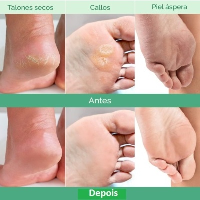 Comparação visual de pés com talões secos, calos e pele áspera antes e depois do tratamento.