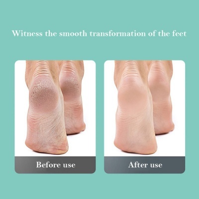 Comparação do calcanhar antes e depois do uso de um produto para pés