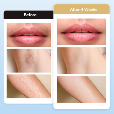 Comparação de antes e depois de 4 semanas mostrando lábios, axila e braço