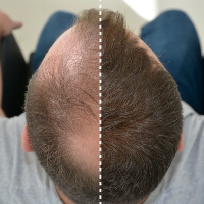 Diferença no volume de cabelo numa cabeça masculina vista de cima, metade calva e metade com cabelo denso.