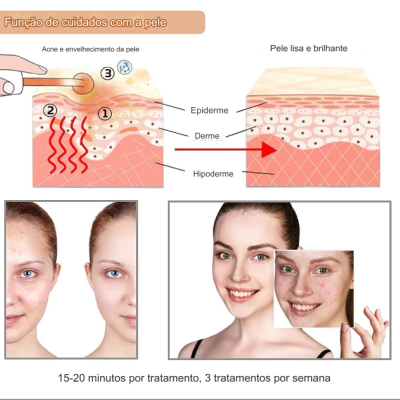 Diagrama da pele com antes e depois de tratamento facial em duas mulheres