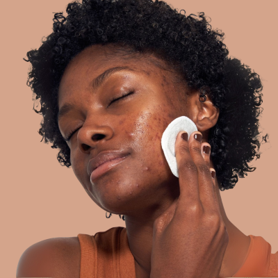 Mulher com disco de algodão a limpar o rosto acneico