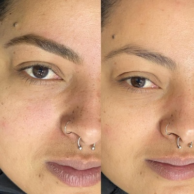 Rosto de pessoa com piercings no nariz, comparação lado esquerdo com sardas e lado direito pele uniforme.