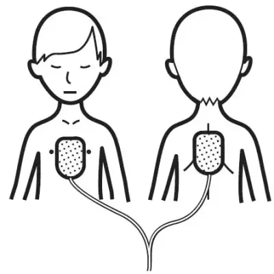 Desenho simples de duas figuras humanas com eletrodos retangulares no peito e nas costas e fios conectados