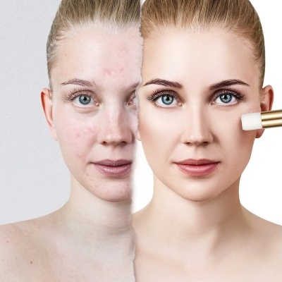 Rosto dividido ao meio com pele com acne e limpa, pincel aplica base líquida