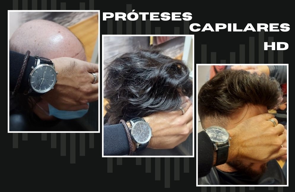 Próteses capilares HD