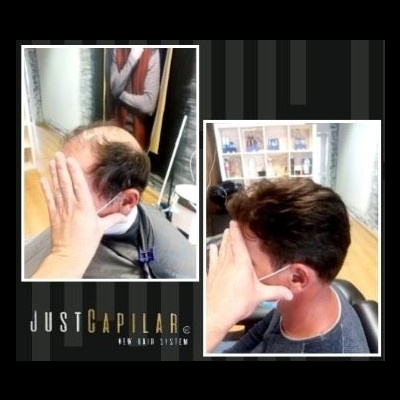 Antes e depois tratamento capilar mostrando cabelo ralo e depois cabelo cheio