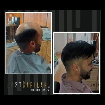Antes e depois do corte de cabelo masculino com texto JUSTCAPILAR NEW HAIR SYSTEM.