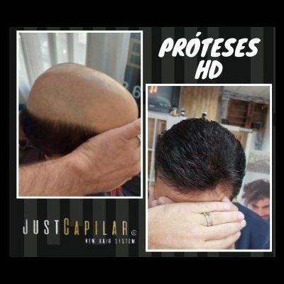 Antes e depois de prótese capilar HD com logo JustCapilar e texto PRÓTESES HD