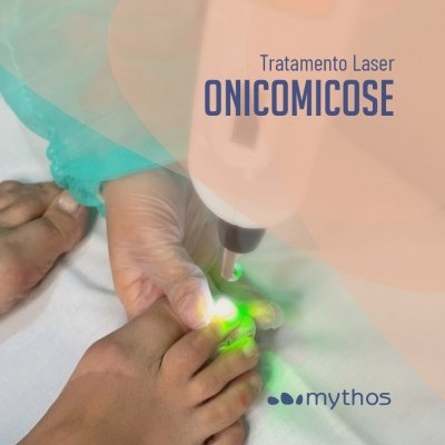 Tratamento laser de onicomicose num pé com luz verde e texto explicativo
