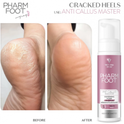 Antes e depois do calcanhar seco e rachado após uso do creme PHARM FOOT ANTI CALLUS MASTER.