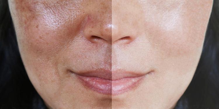 Rosto feminino dividido ao meio mostrando diferença na textura e cor da pele