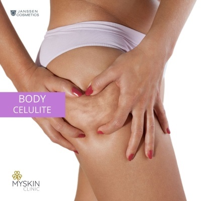 Pernas femininas com celulite e mãos espremendo pele, texto JANSSEN COSMETICS e BODY CELULITE