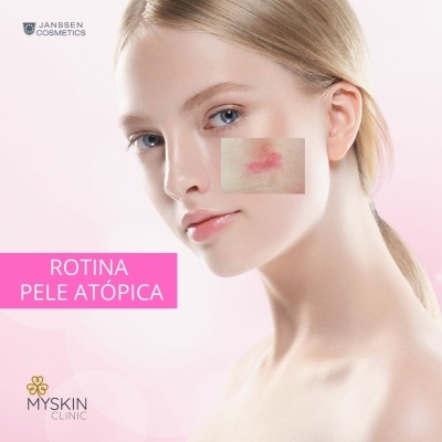 Mulher com pele clara e mancha vermelha na bochecha, texto ROTINA PELE ATÓPICA