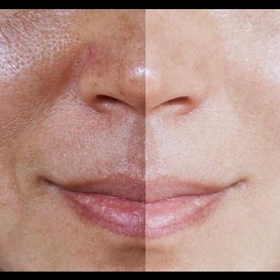 Rosto feminino dividido ao meio mostrando diferença na textura e cor da pele