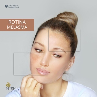 Rosto de mulher com manchas de melasma e texto ROTINA MELASMA