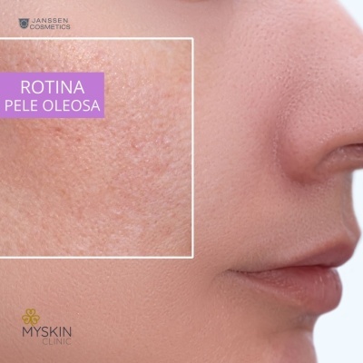 Close-up de pele oleosa no rosto humano com texto e logos visíveis